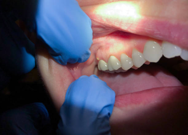 Best Dentist for Tooth Abscess  in Ocean Bluff Brant Rock, MA